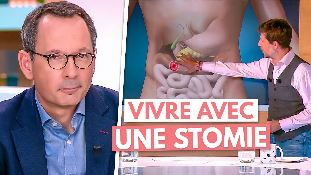 Combien de temps peut-on vivre avec une stomie – Dévoilons la vérité sur la durée de vie générale !