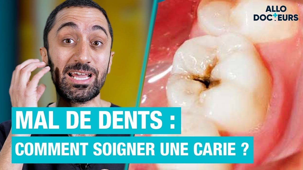 Combien de temps faut-il pour soigner une carie dentaire ? Découvrez les détails ici !